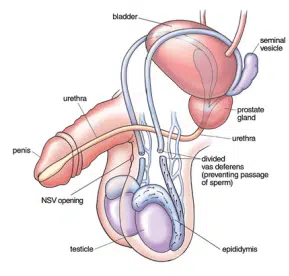 Anatomical drawing of a scrotum after vasectomy